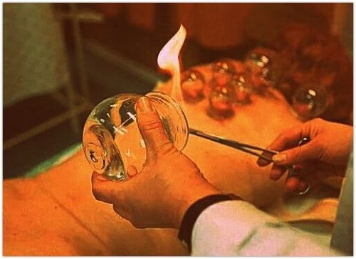 Nauka stawiania baniek